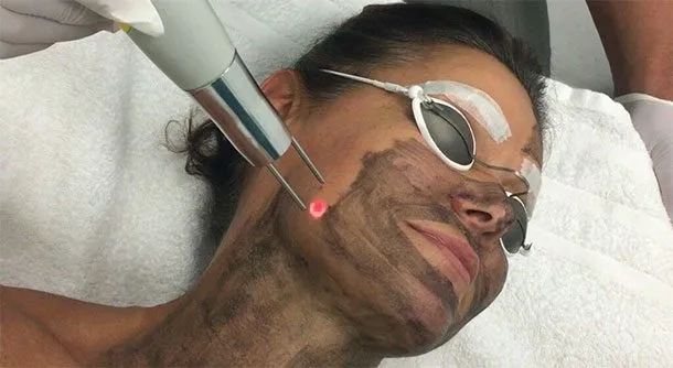 Carbon peel laser at CHANRI Clinic