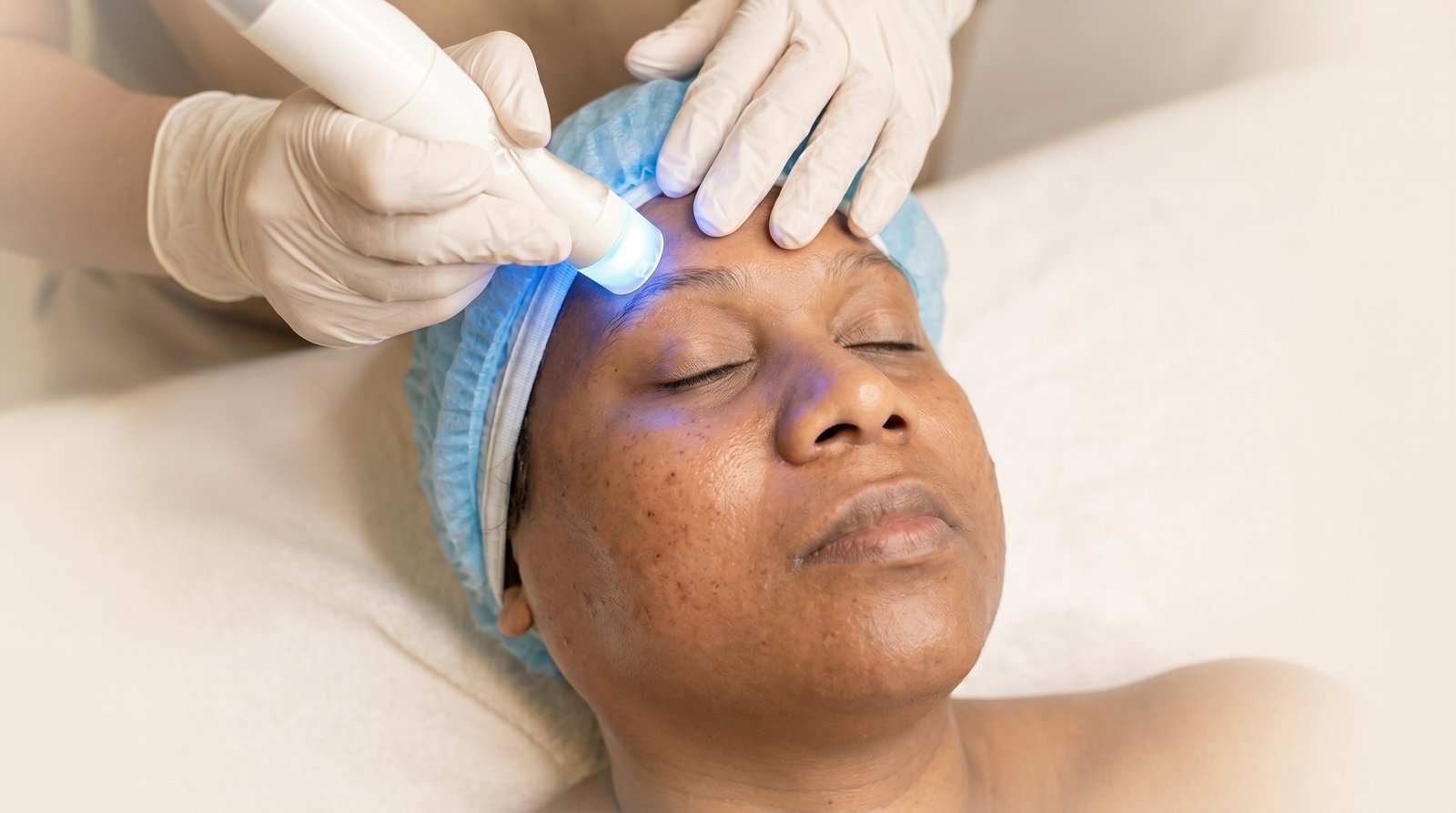 Microdermabrasion at CHANRI Clinic
