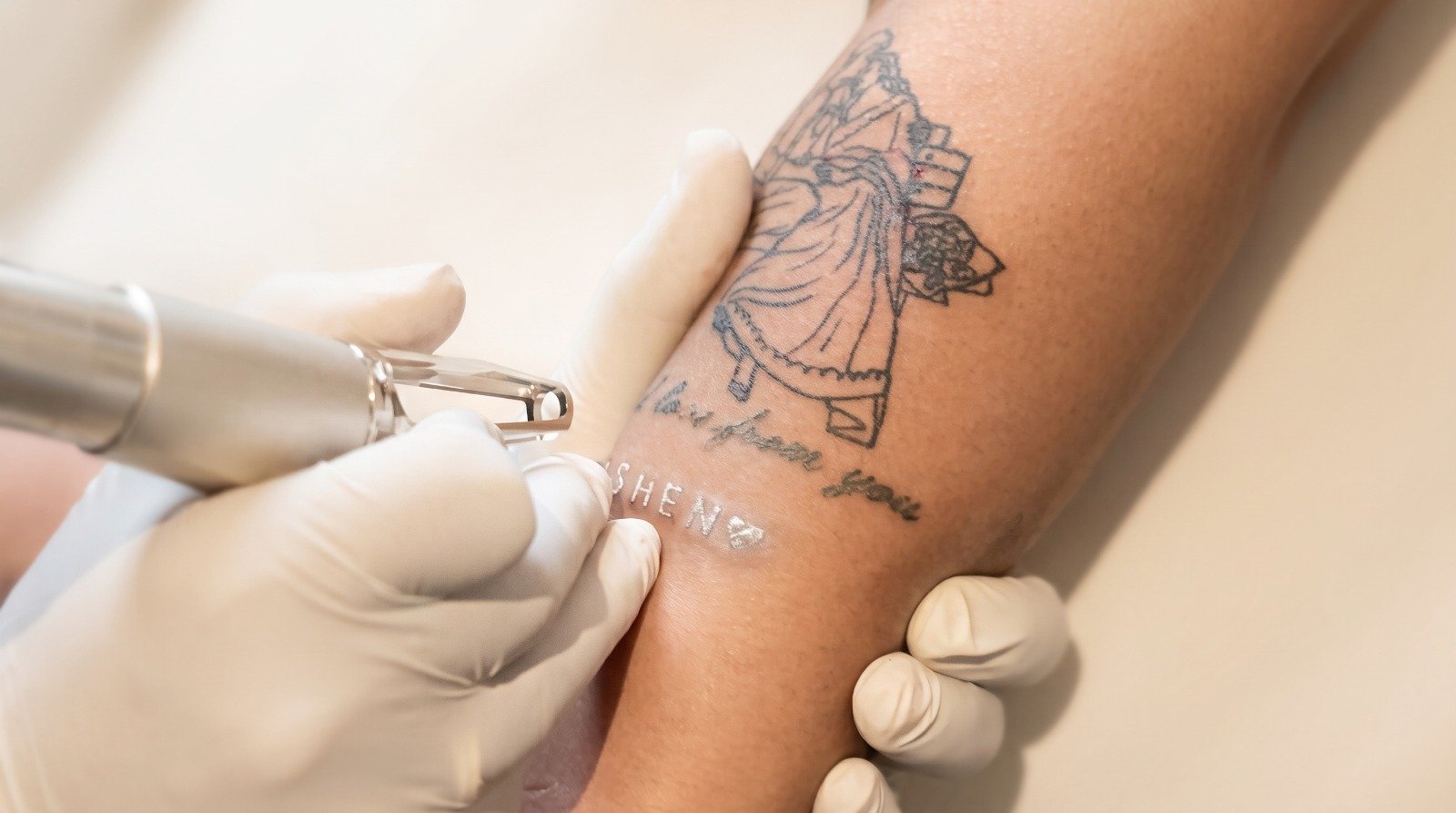 Tattoo removal laser at CHANRI Clinic