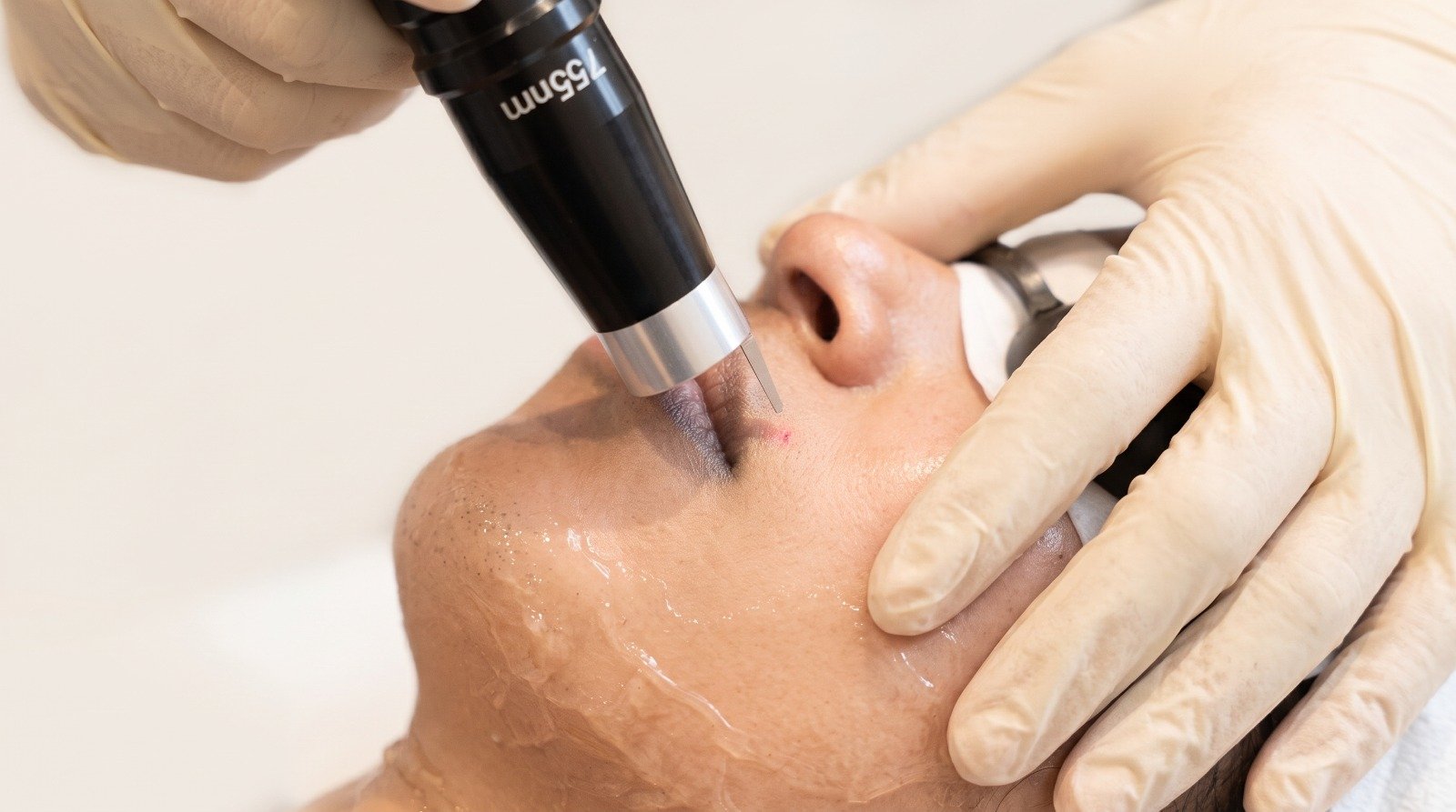 Laser treatment at CHANRI Clinic